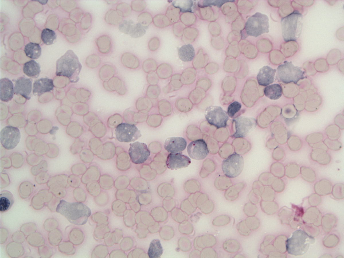 Marrow aspirate blasts PAS